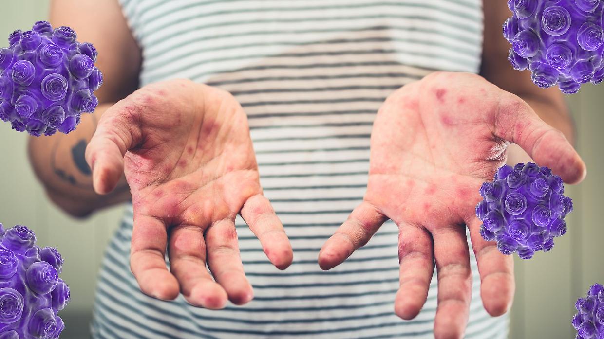 Morbillo, boom di contagi in Europa: oltre 127 mila casi nel 2024, il livello più alto degli ultimi 25 anni